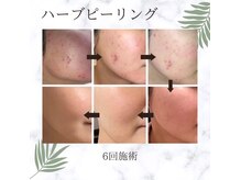 ニキビ・肌荒れに予防にハーブピーリング！！