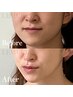 【一度で韓国女優のような水光肌に】韓国肌管理×輪郭三点小顔調整