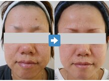 肌質改善サロン 姫路駅前店/肌質改善:シミの緩和