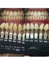 トウキョウスワーズ 池袋店(TOKYO SWRS)/#ホワイトニング #池袋 #渋谷