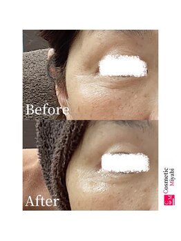 コスメティック雅/【目元の小じわ改善】