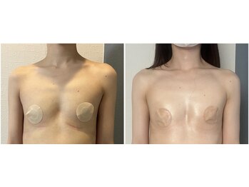 モア(moa)/デコルテの骨ぼねしさも!