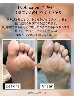 エム 平岸(M)/【タコ/魚の目】70代