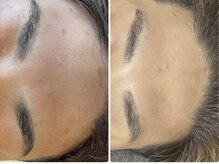 ラヴィ(Ravi)/繰り返すニキビケア