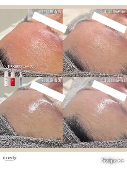 クレヴィー(Creviy)/陶肌ピール