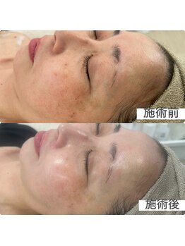 リアン(Lien)/1度でもくすみ肌が明るい肌へ♪