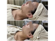 メイス 福井店(MEIS)の雰囲気（【セラピール×MEIS】before(1回目)after(3回目)）