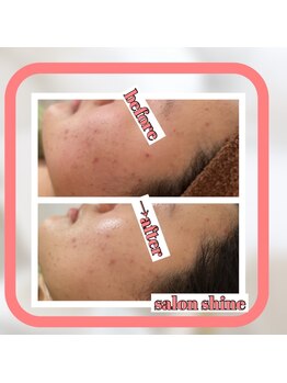 サロンシャイン(Salon Shine)/REVIハーブ１回