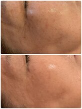 ミラ(Mila)/フォト４回/ポレーション３回