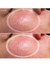 ブライズ(BRISE)/赤みと毛穴ケア