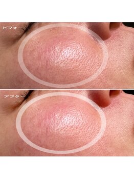 ブライズ(BRISE)/赤みと毛穴ケア