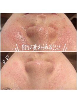 OBS新潟整骨院/いつも同じところが荒れる？