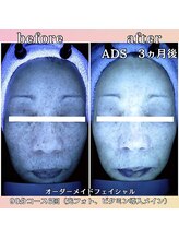 プリマジュール/隠れシミに働きかける！