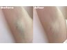 ワキ脱毛¥2500《高出力の高い効果に驚き！》夏までまだ間に合う★