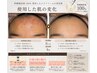 LUXIA極コース【最高峰ケア】エクソソーム×水素肌質管理×リンパ 120分
