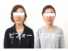 ビューティスタジオＫ/小顔矯正ビフォーアフター