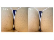 エミルカ(EMILUCA)/ハーブピーリングお尻にオススメ