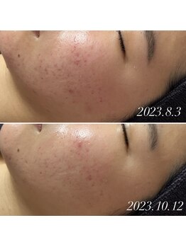 スピカ(Spica)/2ヶ月でも肌は変われる!