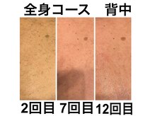 ピノ 西尾店(PINO)/【メンズ脱毛】背中/全身脱毛