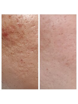 ルルドフォンテ(rurudo fonte.)/ララピールでツルツル肌