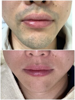 フォーユー 飯能店(Foryou)/男性ヒゲ 青髭も綺麗に