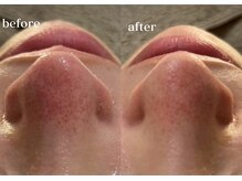 リスタ(RSTA)/【BEFORE/AFTER】