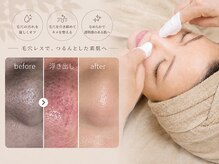 アネラ(ANELA)の雰囲気（【新技法エクストラクション】1回の肌質変化＃毛穴＃黒ずみ）