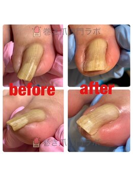 巻き爪専門ラボ 豊田店/巻き爪