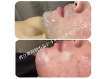 トレテル/ヒゲ脱毛8回目ビフォーアフター