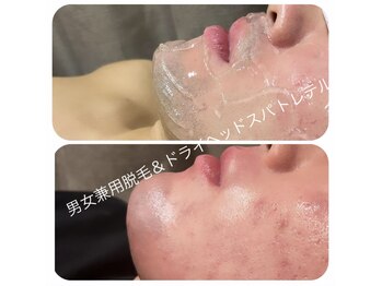 トレテル/ヒゲ脱毛8回目ビフォーアフター