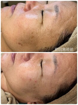 フィオーレ(fiore)/1回の施術でシミしわに変化！