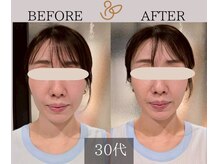 チョコバリ プラス(chocobari plus)/小顔×リフトアップ(美容)30代