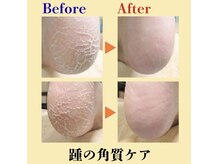 巻き爪補正店 赤羽店の雰囲気（踵の角質、たこ、魚の目でお悩みの方へ［フットケア］［赤羽］）