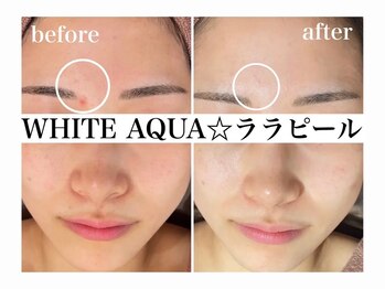 ホワイトアクア 加古川店(WHITE AQUA)/ララピールで水光肌に/加古川