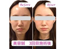 お悩みに合わせて、オーダーメイドで美容鍼灸ができます。