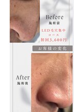 美箱 赤坂店/☆集中毛穴洗浄コース☆