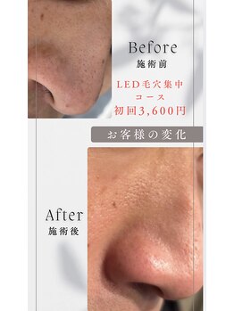 美箱 赤坂店/☆集中毛穴洗浄コース☆