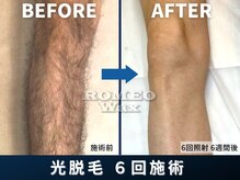 ロミオワックス ジュリエットワックス 新宿店(ROMEO Wax Juliet Wax)/光脱毛6回コース完了後6週間経過