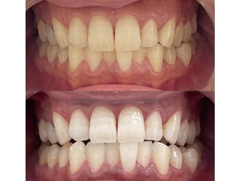 ホワイト 福岡博多店(WHITE)/ホワイトニング通い放題ビフォー