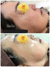 ビエル(Bielle)/毎年、季節的な肌荒れで困ります