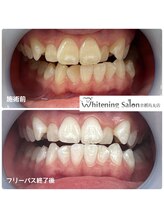 ホワイトニングサロン 京都烏丸店/ホワイトニング施術例