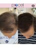 【NEW】☆育毛促進☆髪育エステ☆髪の毛も生まれ変わる！¥60,000
