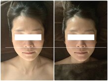 アベリア リュウ(Aberia Lieu)/頭蓋小顔矯正/小顔矯正