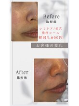 美箱 赤坂店/美容原液と毛穴洗浄でシミケア！