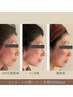 高周波インモード《全顔》脂肪分解&リフトUP＆ボリュームUP：TOTALデザイン