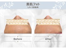 セルフクリア(SELF CLEAR)/