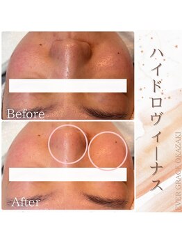 リラベル(Lira Belle)/ハイドロヴィーナス