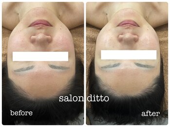 サロンディト(ditto)/【施術3回】クイック小顔コルギ