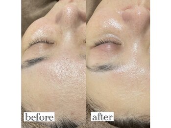 アンドエスビューティ(&S Beauty)/乳酸ピーリング