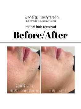 アイラッシュサロン ドール(Doll)/【メンズ】ヒゲ脱毛